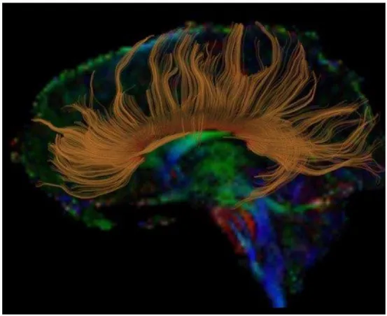 Figure 13. Tractographie des fibres du corps calleux d’un cerveau humain [18]. 