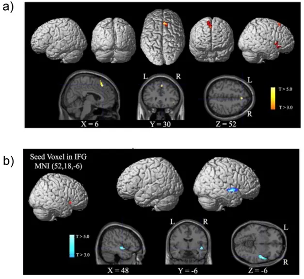 Figure 5: Cortical regions in the Inferior Frontal Gyrus (IFG) and Superior Medial  Frontal Cortex (Pre-SMA) associated with an attentional bottleneck are activated during  inattentional deafness (a)