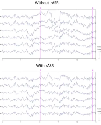 Figure 2. Up—Sample of EEG data before rASR processing for one subject. Sample of the same EEG data after rASR processing.