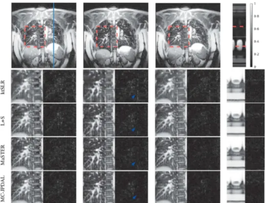 Fig. 3. Reconstruction of the coronal lung MRI scan using different algorithms: frame 1, 10 and 19 and the temporal profile (left to right)