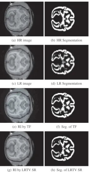 Fig. 2. Experimental results showing one axial slice of the data set: (a) the observed LR image, (b) the super-resolved image using TF and (c) the super-resolved image using LRTV