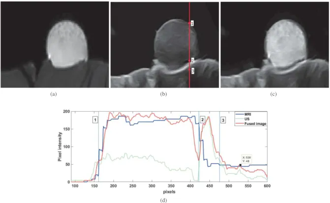 Fig. 4. Example of image fusion using data acquired on the proposed phantom: (a) MR image, (b) US image, (c) fused MR and US image, (d) normalized profiles corresponding to the vertical in (b) extracted from MR, US and fused images.