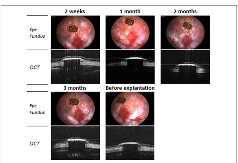 FIGURE 9 | Optical coherence tomography (OCT) and eye fundus images of a 100/80/12 implant in subretinal position during the implantation period.