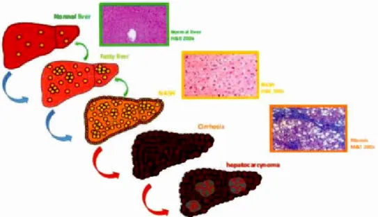 Figure  1.12.  Représentation  schématique  de  la  progression  de  la  stéatose  hépatique