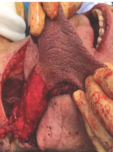 FIGURE 4  Postoperative result. Super thin external pudendal  artery flap (STE PA) flap inset in the defect after sutures 