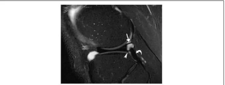 Figure 3 : Image IRM pondérée en T2 avec image de la graisse supprimée, vue sagittale du genou d’un  homme de 25 ans (d’après Rosas, 2006) 