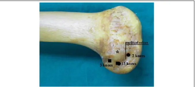 Figure 14 :  Emplacement schématique des différents sites d’insertion du tendon poplité (d’après  Jung et al., 2010) 