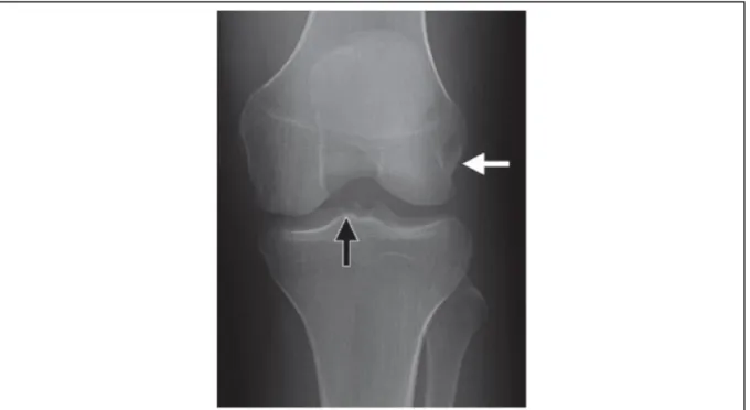 Figure 17 : Radiographie antéro-postérieure de l’articulation du grasset mettant en évidence une  avulsion osseuse au site d’insertion du tendon poplité (d’après Jadhav, 2014) 