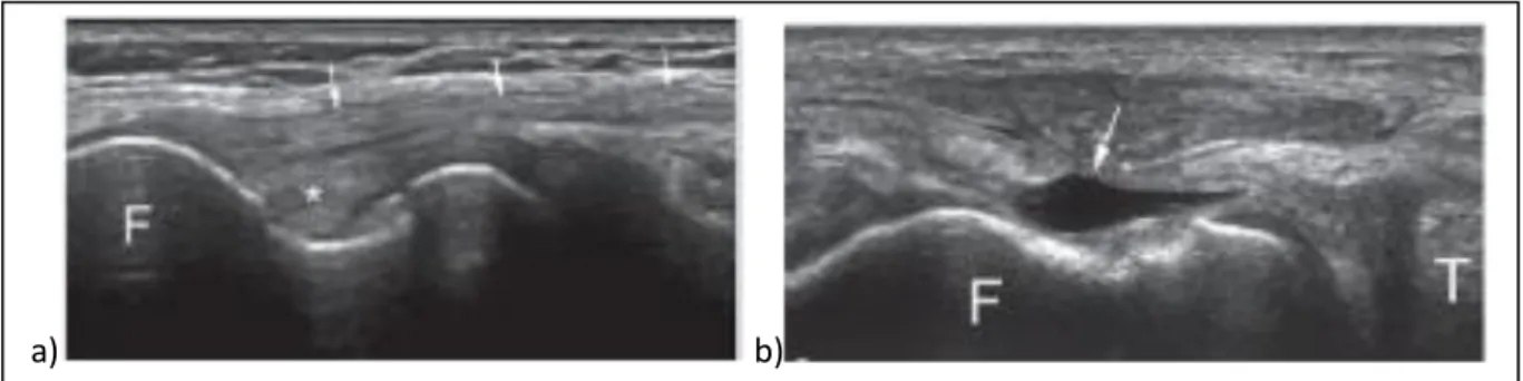 Figure 18 : Images échographiques de a) l’insertion proximale normale du LCL (flèches) et du  tendon poplité (*) dans la fossette poplitée, b) fossette poplitée vide (flèche) suite à une 