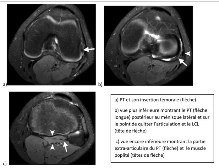 Figure 19 :  Images IRM normales du tendon poplité, en coupe axiale pondérées en DP et avec  saturation de graisse (d’après Jadhav et al., 2014)