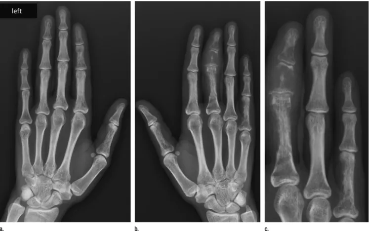 Figure 3:   Coronal reconstructed CT image of the right hand ob- ob-tained with the bone window setting.