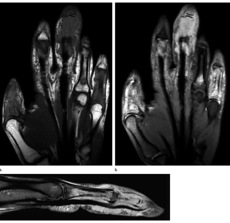Figure 4:  (a)  Coronal T1-weighted (repetition time msec/echo time msec, 508/20) MR image of the right hand