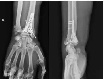 Fig. 5. Patient #3, antero-posterior and lateral radiographs after surgery.