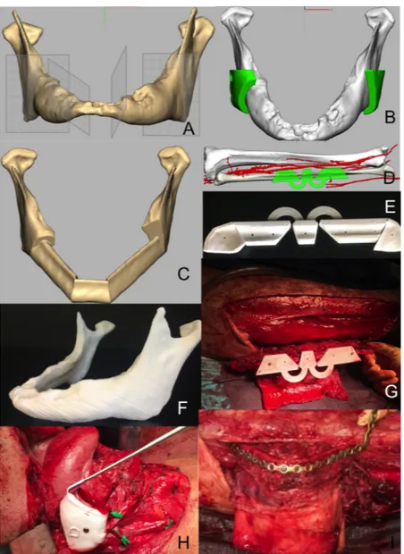 Fig. 2. Patient with squamous cell carcinoma of the oral ﬂoor invading the symphysis, the 2 parasymphyses and the left body of the mandible