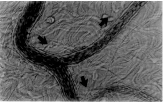 Figure 3.4 – Répartition de globules rouges à une bifurcation avant (figure du haut) et après occlu- occlu-sion (figure du bas) du vaisseau en haut à droite