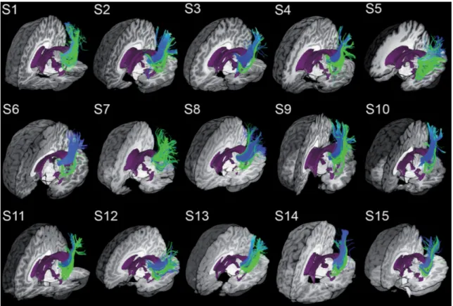 Figure 4.6 qualitatively shows that MAGNET successfully recovered a larger and denser extent of Meyer’s loop for all of our 15 child subjects in comparison with Boolean-based deterministic tractography