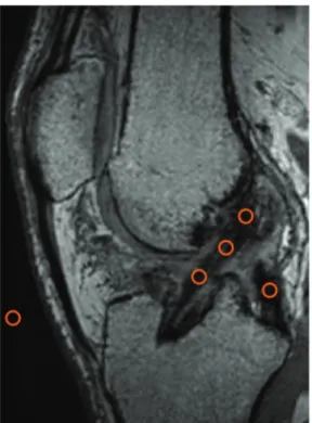 Figure 4. Measurement of the cross-sectional area of the tibial bone tunnel with TeraRecon software using  3-dimensional reconstruction.