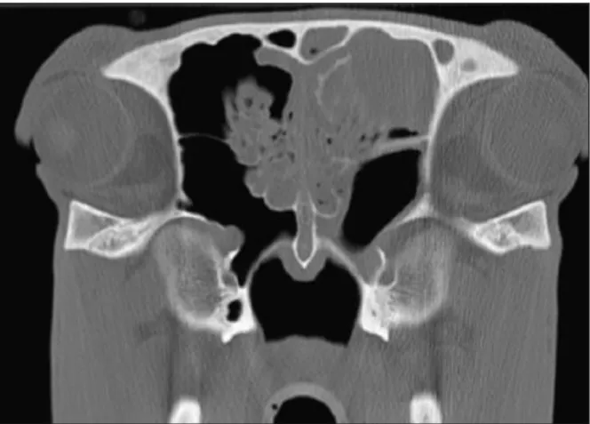 Figure 26 : Image de tomodensitométrie montrant une masse de tissu mou dans le sinus frontal qui a progressé 