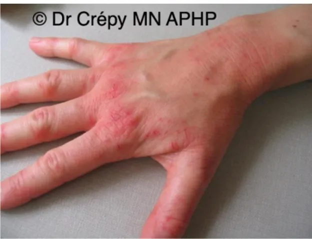 Illustration 3 : Dermatite d'irritation de contact avec nombreuses fissures chez une  infirmière liée à l'utilisation fréquente de savon, antiseptiques et action abrasive d'une brosse 