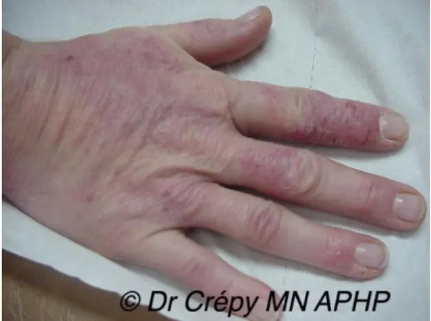 Illustration 4 : Dermatite de contact allergique au glutaraldéhyde de désinfectants chez  une assistante vétérinaire 