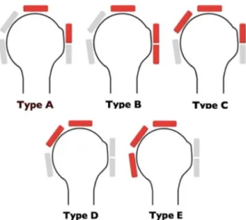Fig. 1. Collin classiﬁcation based on the rotator cuff tendons involved.