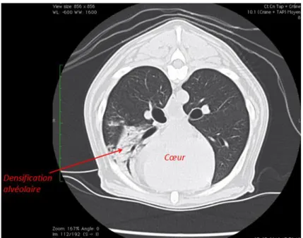 Illustration 9: Image transverse, fenêtre pulmonaire. Densification alvéolaire sur le lobe moyen droit,  compatible avec une broncho-pneumonie par fausse déglutition