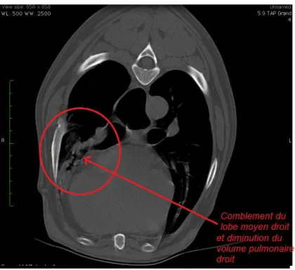 Illustration 16: Image transverse, fenêtre pulmonaire. Comblement du lobe moyen droit associé à une  diminution du volume pulmonaire droit