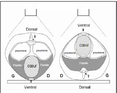 Figure 9 : Représentation schématique d’un épanchement pleural lors d’un décubitus ventral (à  gauche) et dorsal (à droite) 