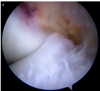 Fig. 1. Arthroscopic view of the anterior tibial spine in contact with the lateral sur- sur-face of the medial femoral condyle during anterior cruciate ligament reconstruction.
