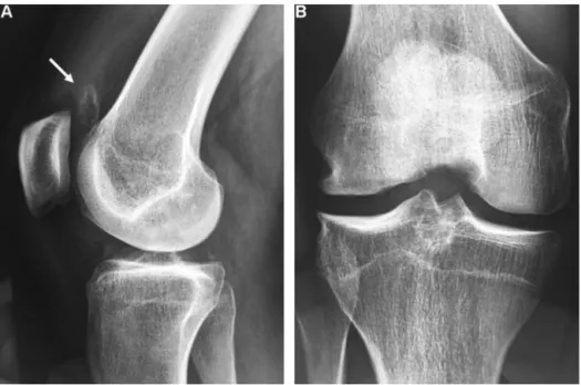 Fig. 11. Osteochondritis dissecans of the medial condyle in an 18-year-old male. A. Fragment loose in the supra-patellar bursa (arrow)