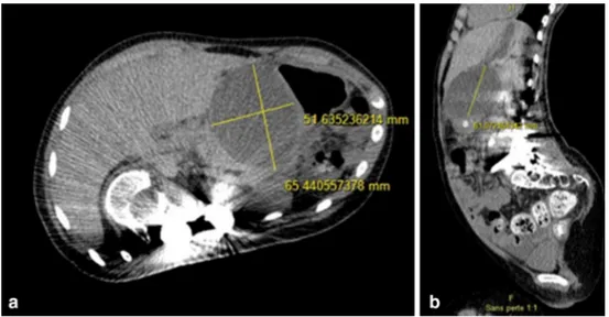 Fig. 4   Abdomino-pelvic CT scan, coronal (a) and axial (b), showing an expanding pancreatic pseudocyst (about 6 cm in diameter)