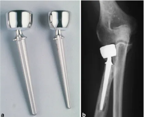 Fig. 5 Pictured here is the first bipolar radial head prosthesis. The Judet RHP (Wright Medical, Arlington, TN, USA) has a collared stem, a 15° neck shaft angle, and a floating articulation; head and stem sizes are interchangeable