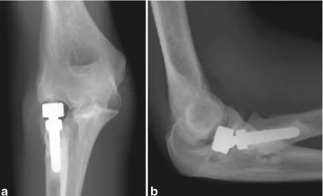 Fig. 8 AP (a) and lateral (b) radiographs demonstrating capitellar wear caused by an overstuffed bipolar radial head implant