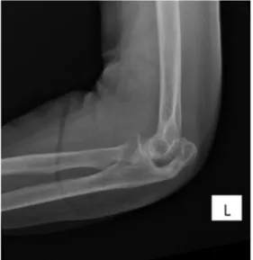 Fig. 1. Non-union fracture.