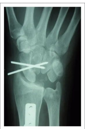 Figure 1. Anteroposterior radiographs with arthrodesis fixed by K-wires.