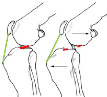 Figure III : Grasset canin en vue latéro-médiale et représentation du ligament croisé crânial  intact (à gauche en rouge) et rompu (en rouge à droite)