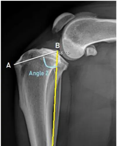 Figure XIV : Radiographie d’un grasset en vue latéro-médiale et représentation de l’angle Z :  le point A représente l’insertion du ligament patellaire sur la tubérosité tibiale, le point B  représente l’éminence intercondylienne du tibia