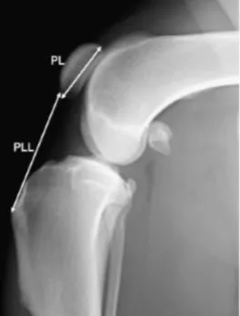 Figure XVI : Radiographie médio-latérale d’un genou de chien sain, illustrant la mesure de la  longueur patellaire (PL) et la longueur du ligament patellaire (PLL)
