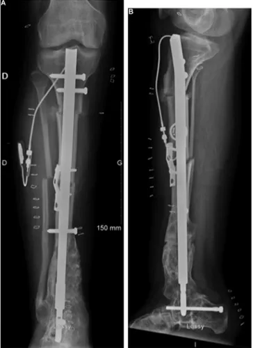 Fig. 6. Postoperative radiographs after distraction osteotomies and rotational realignment via a motorised nail.