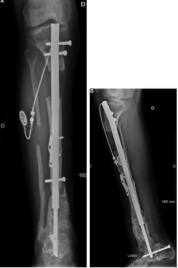 Fig. 7. Radiographs taken 4 months after implantation of the motorised nail, showing a small callus at the proximal metaphysis and a deformity with 30 ◦ of ﬂexion and 15 ◦ of valgus; note the cut-out of a proximal locking nail.