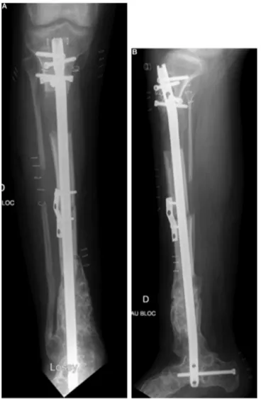 Fig. 8. Postoperative radiographs after revision surgery for realignment using an intramedullary-locking nail; the valgus is fully corrected but the ﬂexion deformity shows