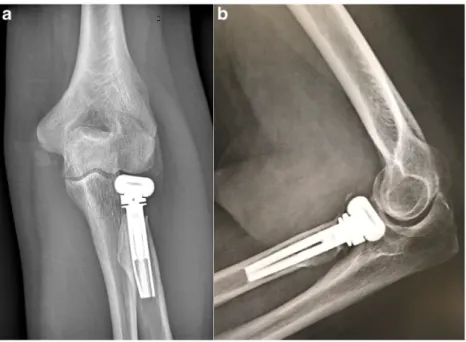 Fig. 3 Anteroposterior (AP) (a) and lateral (b) radiographs of the elbow demonstrating stress shielding around a MoPyC radial head prosthesis