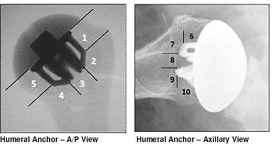 Figure 1 Radiologic classification in true anteroposterior (A/P) and axillary views (humeral classification by Zimmer Biomet).