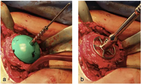 Figure 5 Implantation of Sidus Stem-Free Shoulder System: head sampling (a) and preparation for anchor (b).