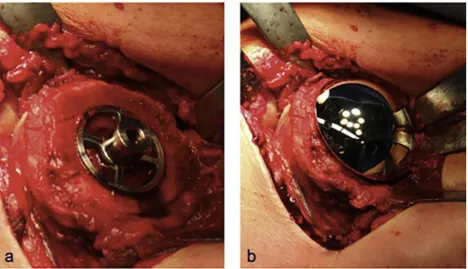 Figure 7 Implantation of Sidus Stem-Free Shoulder System: impacted anchor (a) and humeral head (b).