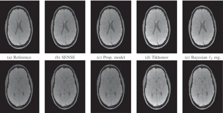 Fig. 1. Processed MRI slices: Reference slices (a), Reconstructed slices using SENSE (b), the proposed model (c), Tikhonov regularization (d), and the Bayesian ℓ 2 regularization algorithm (e).