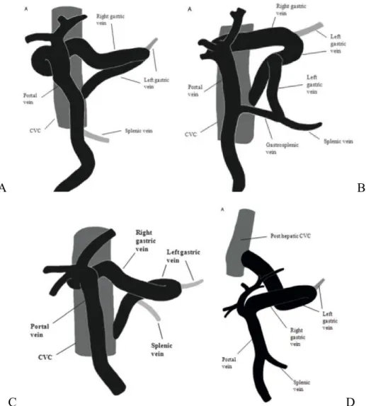 Figure 10 : Représentations schématiques des shunts impliquant la veine gastrique droite 