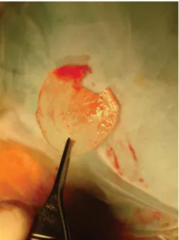 Fig. 4. Example of a deteriorated silicone sheet removed from a patient that had undergone previous surgery in another structure without fixation of the sheet