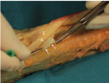 Fig. 1 Transection with a 21 G needle of the retinaculum of the first extensor compartment in a cadaver specimen