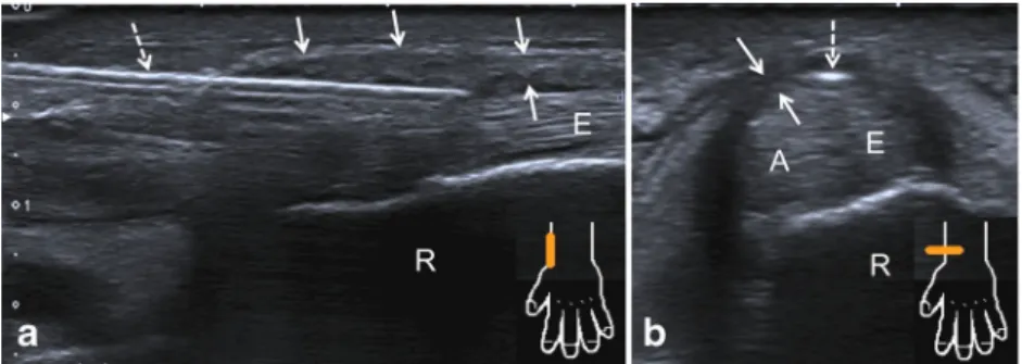 Fig. 6 Example of a release being performed in the left wrist of a 57 year old female patient with type 1 de Quervain's tenosynovitis